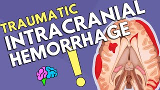 Intracranial Hemorrhage [upl. by Galasyn]