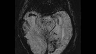 Acute MCA Infarct [upl. by Evelinn381]