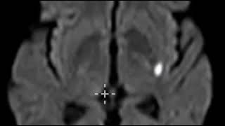 Acute lacunar infarction basal ganglia [upl. by Uaeb213]