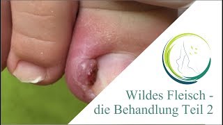 Wildes Fleisch die Behandlung Teil 2 [upl. by Johnath836]