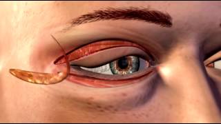 Cosmetic Eye and Eyelid Surgery  3D Medical Animation  ABP © [upl. by Amitarp298]