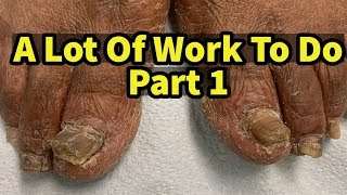 Severe Fungal Fungus Toenails A Lot Of Work To Do Part 1 [upl. by Noillimaxam943]