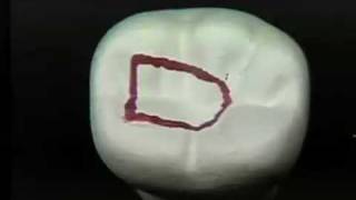 Endodontic Cavity Preparation  Phase I  Posterior [upl. by Fernandina]