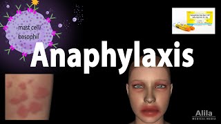 Anaphylaxis Animation [upl. by Priebe]