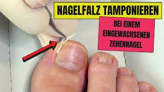 Nagel tamponieren bei EINGEWACHSENEN NÄGELN  Eingewachsene Nägel endlich loswerden [upl. by Eelegna]