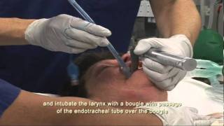 extubation correct technique [upl. by Sherburn]