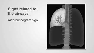 Bronchial and Vesicular Breath Sounds [upl. by Enneiluj]