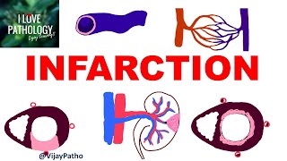 INFARCTION Causes Types Morphology [upl. by Hollah]