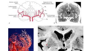 The lenticulostriate vessels and lacunar infarcts [upl. by Sarkaria]