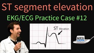 ST Elevation  EKG  ECG Interpretation Case 12 STEMI MI ACS [upl. by Bathilda]