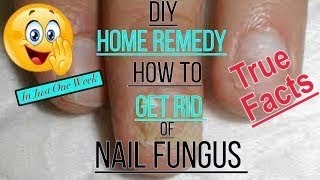 DIY Fingernail Fungus Treatment Home Remedy  Please read the description 101 [upl. by Frodi]