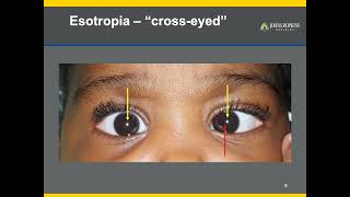 Strabismus  A Patient Guide to Misalignments of the Eyes [upl. by Layor840]