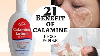 CALAMINE lotion  Lacto calamine lotion uses in detail side effects [upl. by Berke]