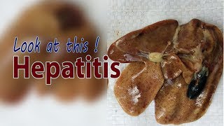 Hepatitis in Broiler Chicken Clinical Signs Poultry Farming [upl. by Pedaias371]