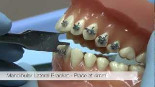 American Orthodontics Alexander LTS Brackets  Bracket Placement Video [upl. by Paco174]