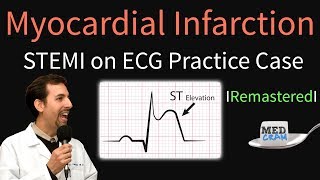 Myocardial Infarction  STEMI on ECG  Practice EKG [upl. by Plossl206]