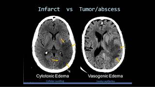 Intro to Head CT Part II Evaluation of Ischemic Stroke [upl. by Aoh782]