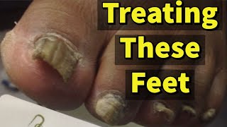 Treating These Feet A Patient With Fungal Toenails [upl. by Calli574]