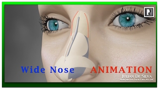 Rhinoplasty Animation  How can a Wide nose be narrowed [upl. by Craddock]