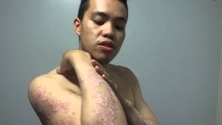 Psoriasis  Consentyx Journey day 1 Biological treatment [upl. by Nosniv]