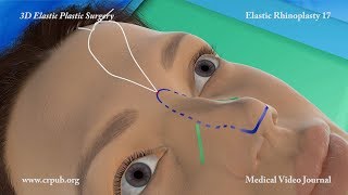 3D Elastic Rhinoplasty [upl. by Ylro]