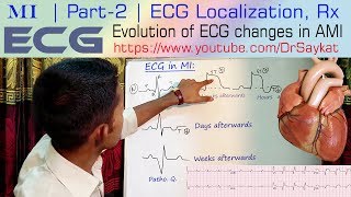 MI  Part 2  ECG Localization amp Treatment of Myocardial Infarction  Dr Saykat [upl. by Aihsemak74]