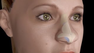 Bulbous Large Nasal Tip Nose Job Rhinoplasty [upl. by Crist671]