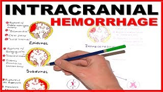 Intracranial Hemorrhage EpiduralSubduralSubarachnoid overview [upl. by Klinger]