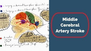 Middle Cerebral Artery Stroke [upl. by Piper605]