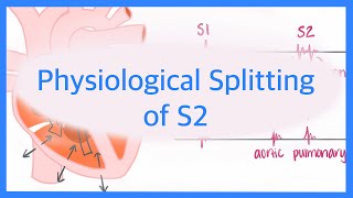 Physiological Splitting of S2 [upl. by Kenti]