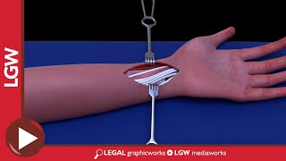 Wrist Fixator Surgery 3D Animation [upl. by Assile]