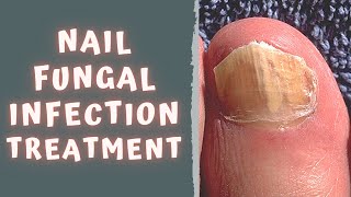 HOW TO TREAT FUNGAL NAIL INFECTION  TINEA UNGUIUM  ONYCHOMYCOSIS [upl. by Nnaeiluj]