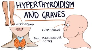 LOW THYROID Symptoms Common and Uncommon 2024 [upl. by Gery]