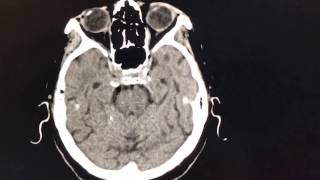 MCA Infarct Stroke [upl. by Ynaitirb314]