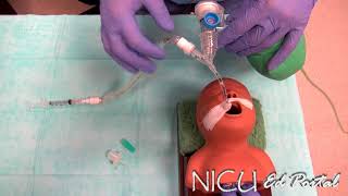 NICU Procedures Surfactant administration in a preterm infant [upl. by Trevlac]