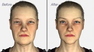 Facelift amp Neck Lift surgery  Dr Julian De Silva  3D medical animation [upl. by Niroht77]