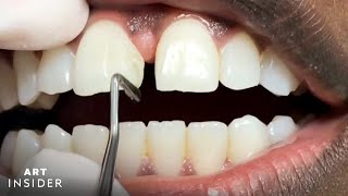 How Tooth Gaps Are Filled  Insider Art [upl. by Scribner]