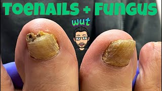 HOW TO CUT THICK TOENAILS WITH FUNGUS [upl. by Heid]