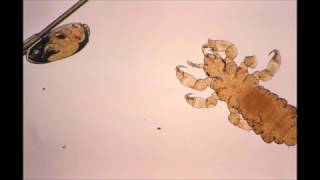 Pediculosis Head and body lice [upl. by Fulmis]