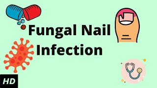 Fungal Nail Infection Causes Signs and Symptoms Diagnosis and Treatment [upl. by Dloreg372]