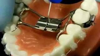 Bracesquestionscom  Orthodontic Jaw Expander How to Turn [upl. by Ihcalam50]