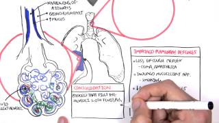 PART I  Pneumonia Overview Lobar and Bronchopneumonia [upl. by Aruasor]