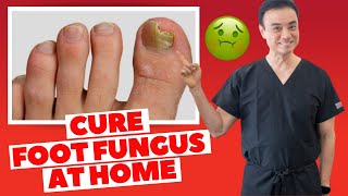 6 Effective HOME REMEDIES To CURE Toenail FUNGUS  Holistic Toenail Fungus Cures Part 2  Dr Kim [upl. by Aikim]