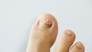 How to prevent and treat nail fungus [upl. by Bullard]