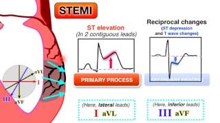 Ischemia 67  STEMI on ECG [upl. by Lleon]