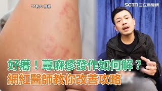 好癢！蕁麻疹發作如何解？網紅醫師教你改善攻略｜三立新聞網SETNcom [upl. by Ulyram746]