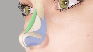 Saddle Nose or Ski Slope Nose Rhinoplasty Nosejob [upl. by Bordiuk]