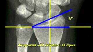 Distal Radius Radiographic Parameters [upl. by Anirav]