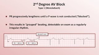 Intro to EKG Interpretation  AV Block [upl. by Yr]