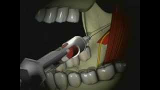 Mandibular Anesthesia  Inferior Alveolar Nerve Block [upl. by Jobey174]